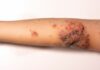 Alarm s turističnih destinacij: impetigo se poleti hitro širi – kako ga prepoznati in ukrepati
