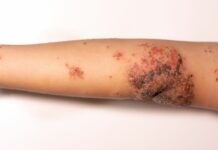 Alarm s turističnih destinacij: impetigo se poleti hitro širi – kako ga prepoznati in ukrepati
