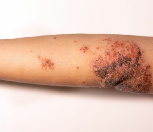 Alarm s turističnih destinacij: impetigo se poleti hitro širi – kako ga prepoznati in ukrepati
