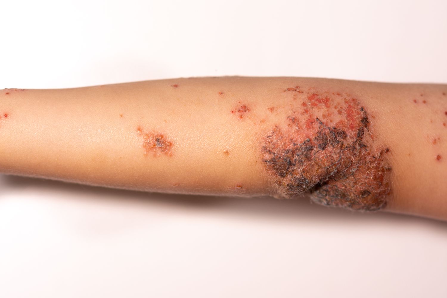 Alarm s turističnih destinacij: impetigo se poleti hitro širi – kako ga prepoznati in ukrepati